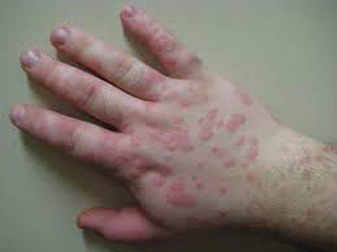 Causes of erythema multiforme