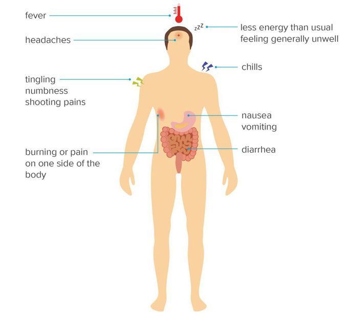 Symptoms of Herpes zoster