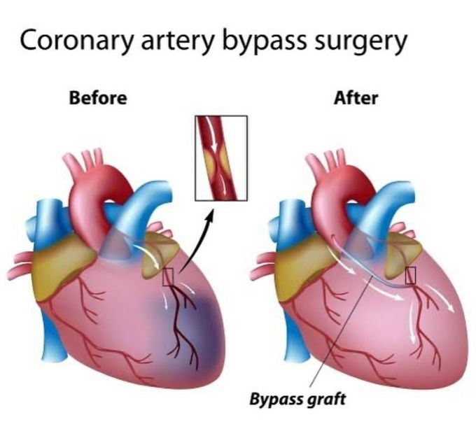 CABG Surgery