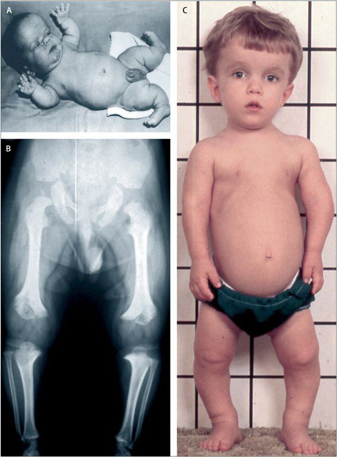 Achondroplasia