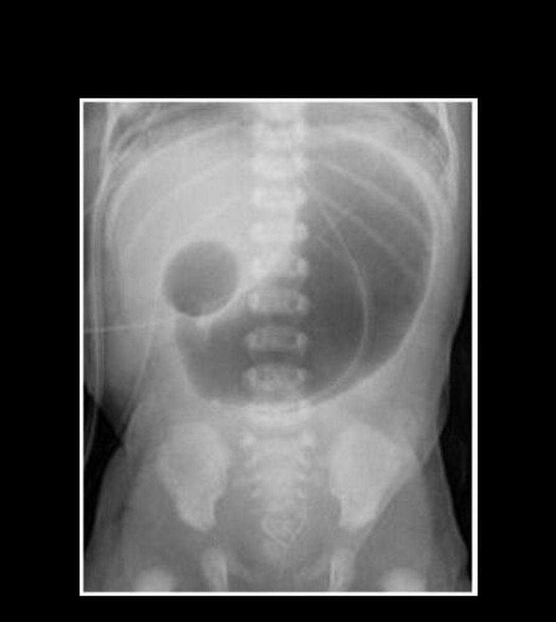 double bubble duodenal atresia