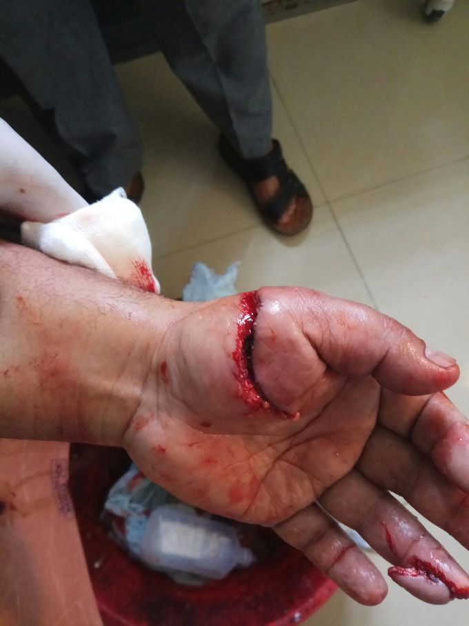 Crush injury