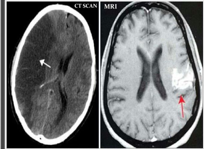Ischemic stroke