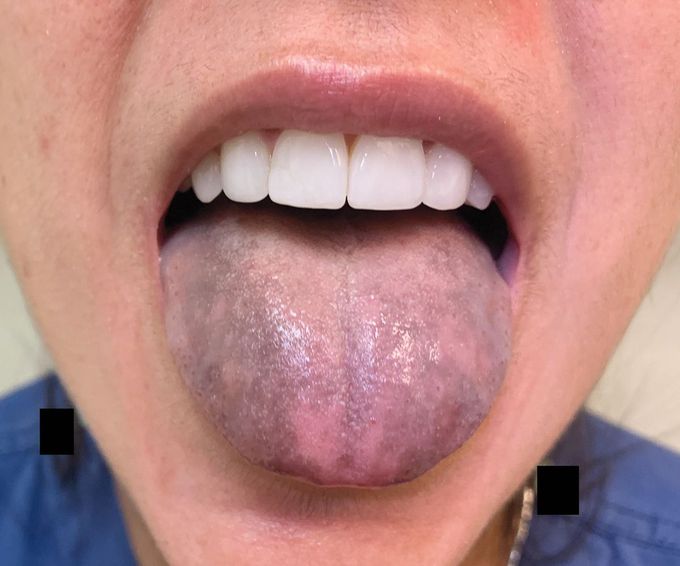 Tongue Discoloration