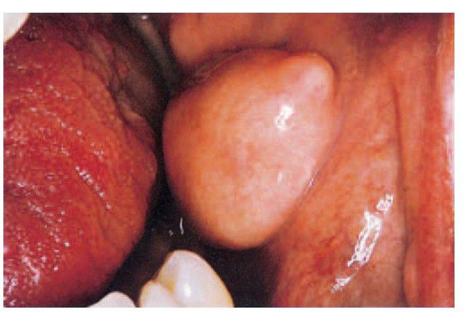 Lipoma
