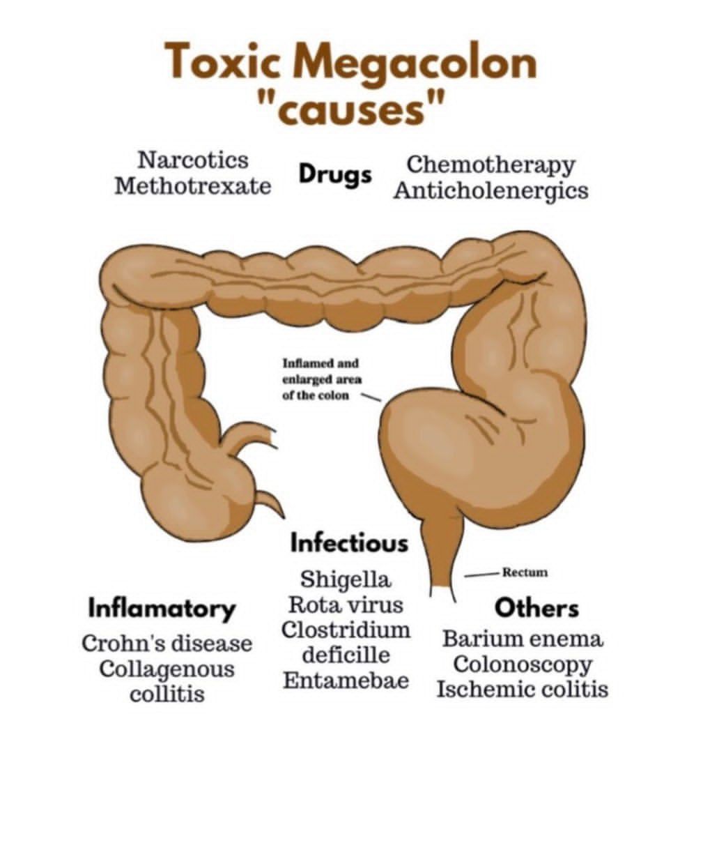 Toxic Megacolon Causes MEDizzy