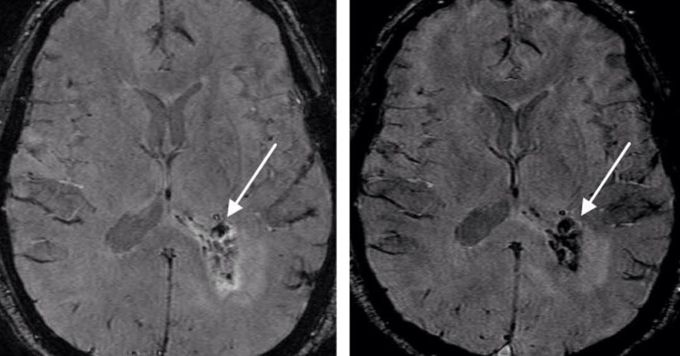 Pre- and Postcontrast SWI
