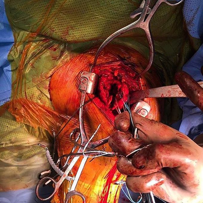 Fracture/dislocation of proximal humerus