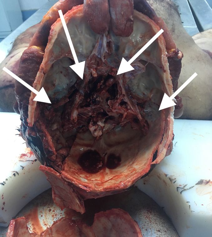 Hinge fracture