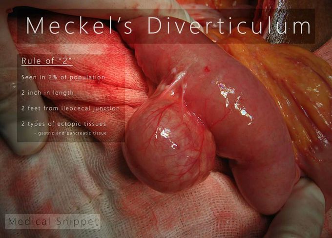 MERKEL'S DIVERTICULUM