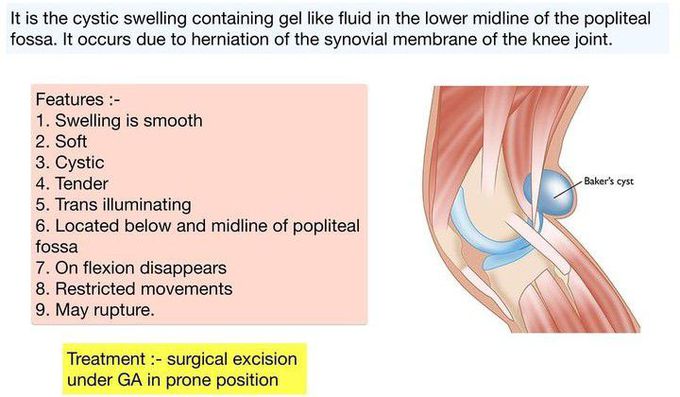 Baker's Cyst