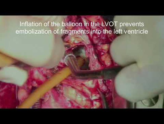Simple Conversion of a Mechanical Bentall to a Biological Bentall