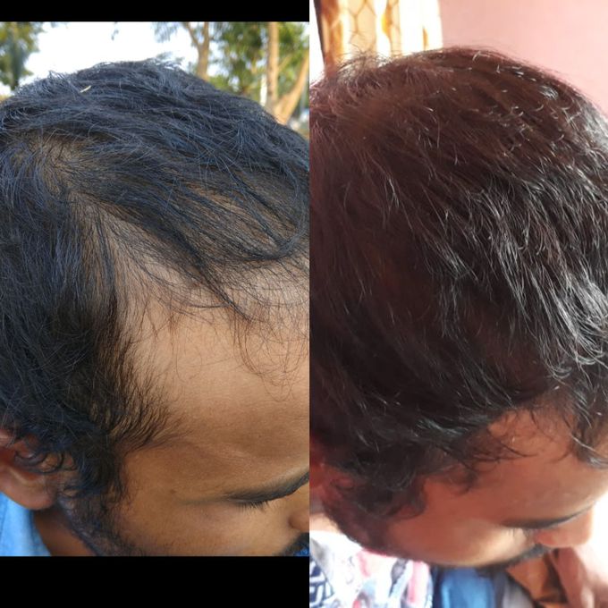 Well treated case of alopecia by myself