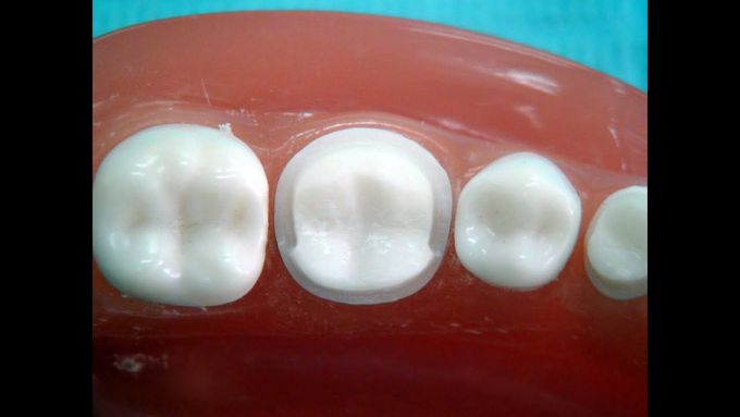Metal ceramic crown preparation