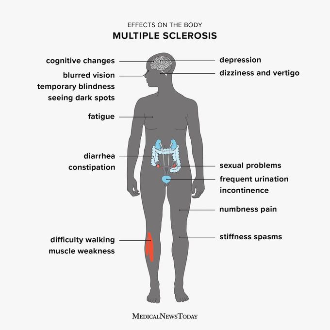 Multiple Sclerosis