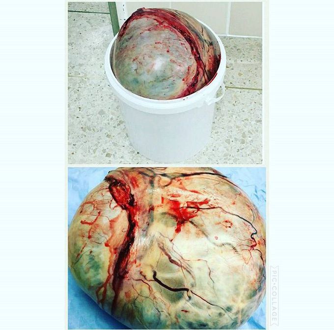 How to quickly lose weight? Huge ovarian cyst = -10kg! 🏐✔️