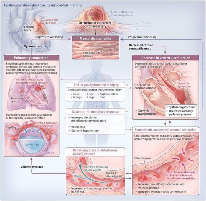 Cardiogenic shock