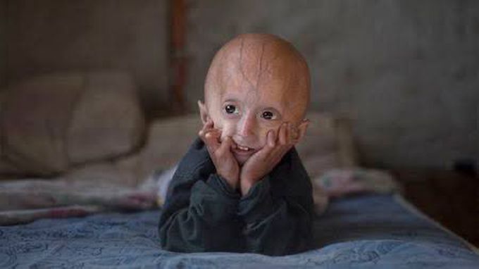 Hutchinson-Gilford syndrome or Progeria