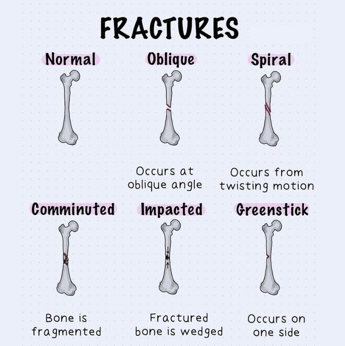 Fractures