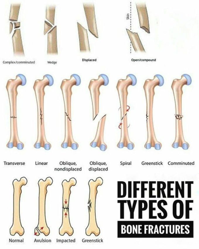 Bone fracture