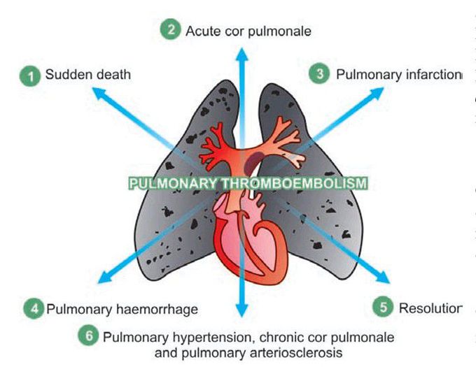 Pulmonary embolism.