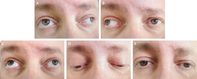 Bilateral Internuclear Ophthalmoplegia in Multiple Sclerosis