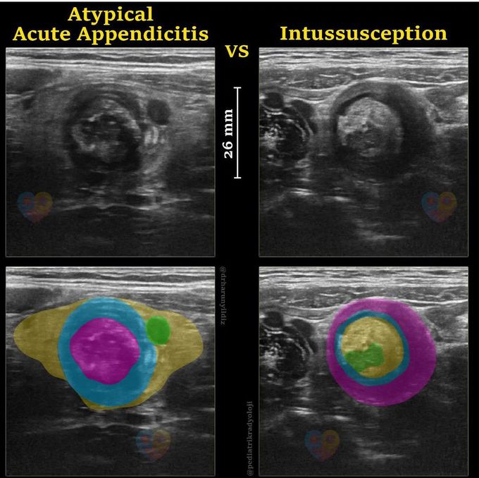 Atypical Acute Appendicitis Vs Intussusception