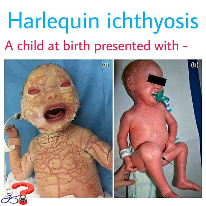 HARLEQUIN ICHTHYOSIS