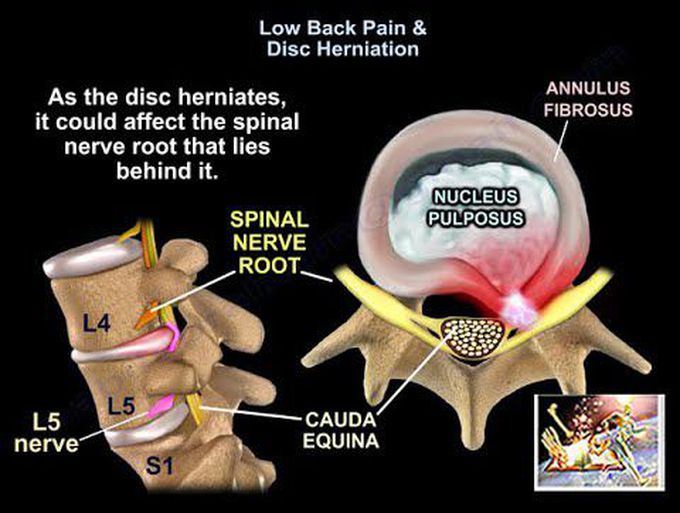 Low Back Pain & Disc Herniation - Everything You Need To Know - Dr. Nabil Ebraheim
