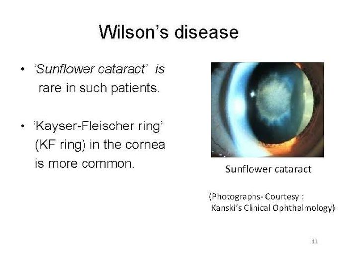 Wilson's Disease