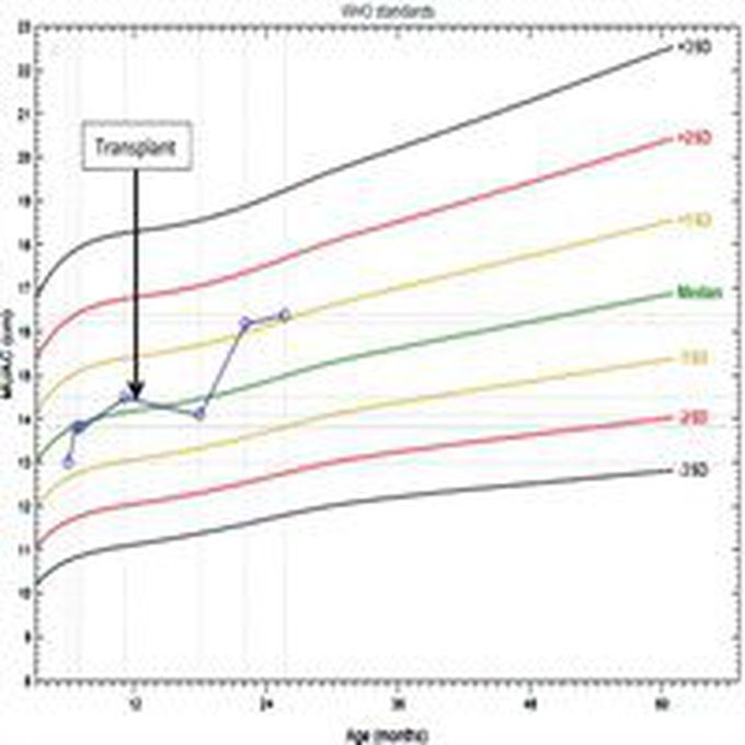 Living donor liver transplant from an HIV-positive mother... : AIDS