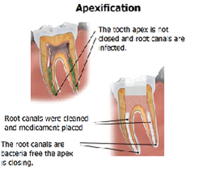 Apexification