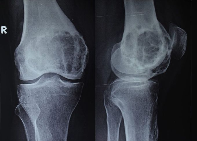 Cause of chondroblastoma