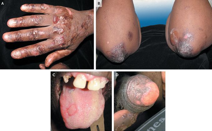 Epidermolysis Bullosa Acquisita