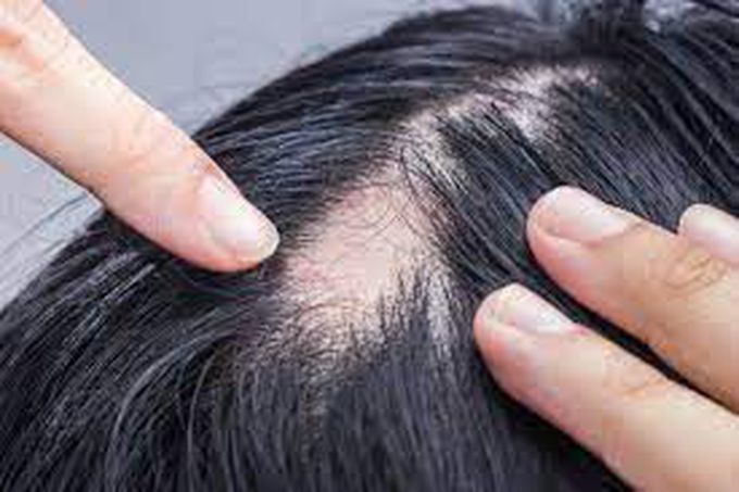 How is alopecia areata managed?