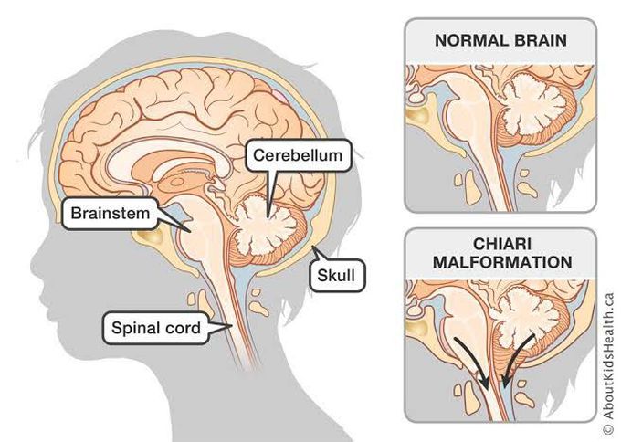 Arnold Chiari Malformation