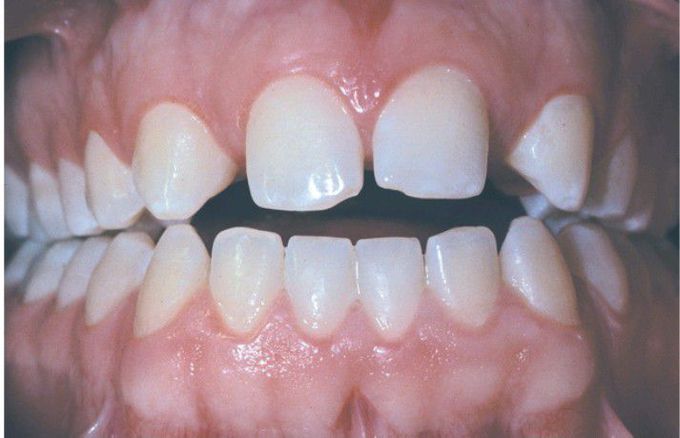 Hypodontia