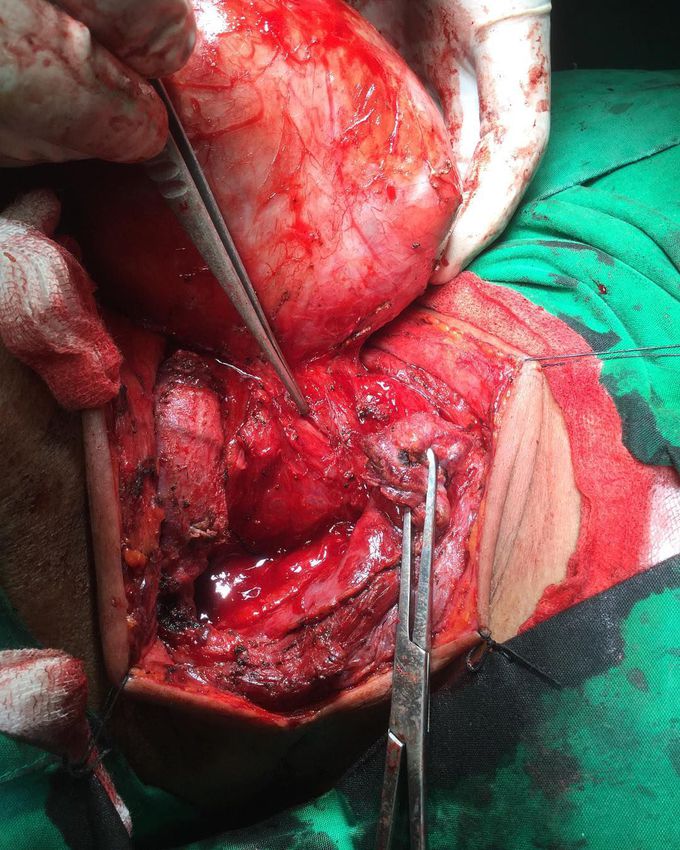 Thyroid cyst and nodules