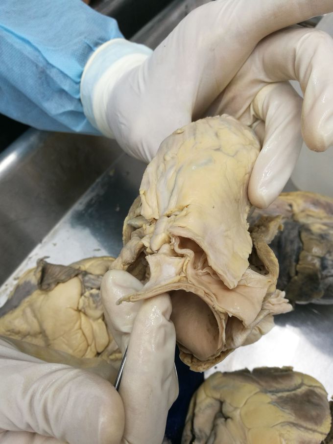 Coronary Arteries