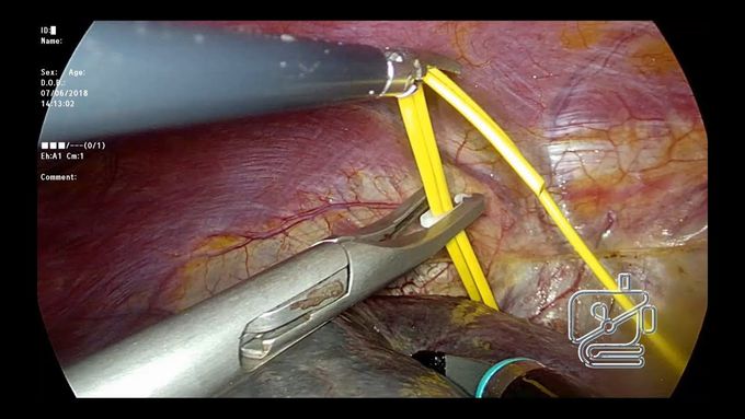 Pure laparoscopic right hepatectomy - Use of hanging maneuver