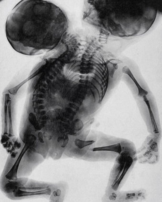 An X-ray of conjoined twins born with two backbones and two heads!! 