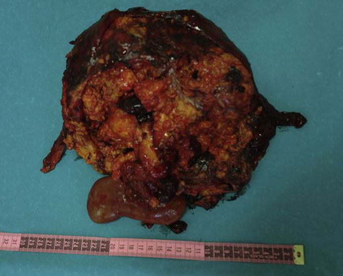 Renal Angiomyolipoma and the Dreaded Wunderlich Syndrome