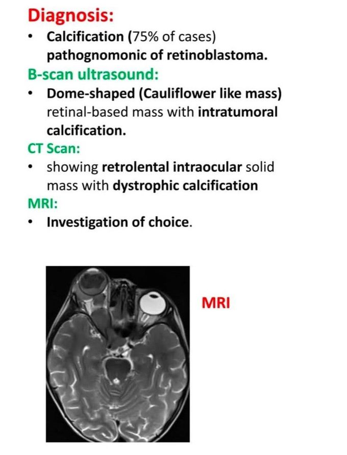 Retinoblastoma II