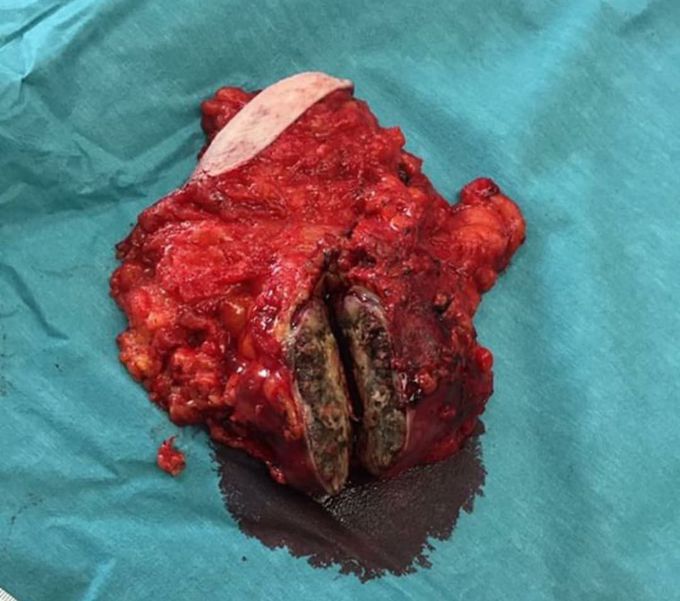 YMPH NODE MELANOMA METASTASIS