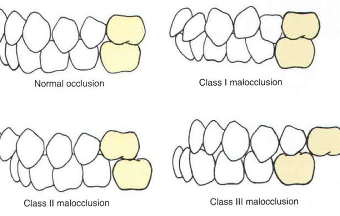 Angles Classification of Malocclusion