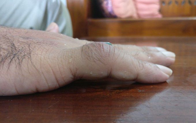 Aftermath of Joint dislocation in little finger