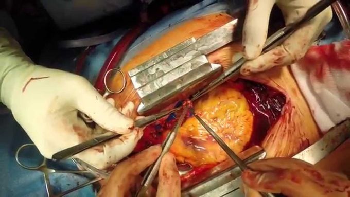 On-pump coronary artery bypass graft surgery