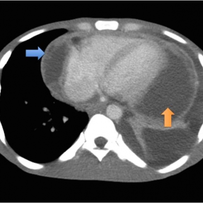 Tuberculous Pericarditis