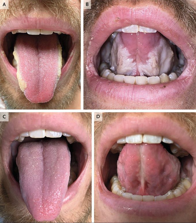 Uremic Stomatitis