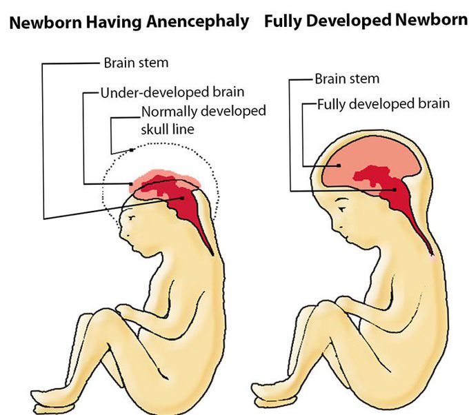 Anencephaly